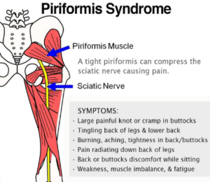 Piriformis syndrom with acupuncture treatment – Ponsonby Wellness Centre