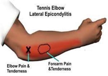 Acupuncture therapy & External humeral epicondylitis – Ponsonby ...