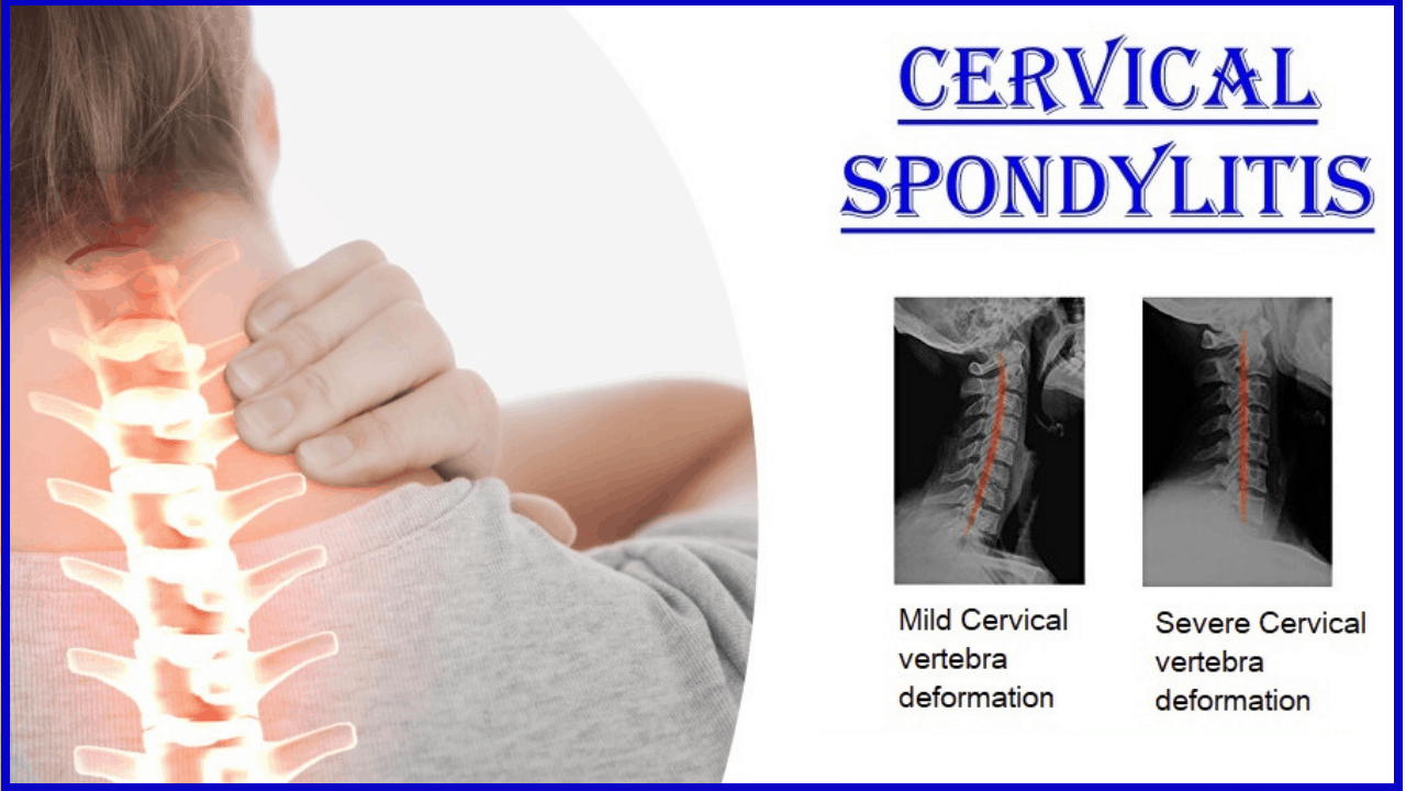 Cervical Spondylosis And Wrist Pain