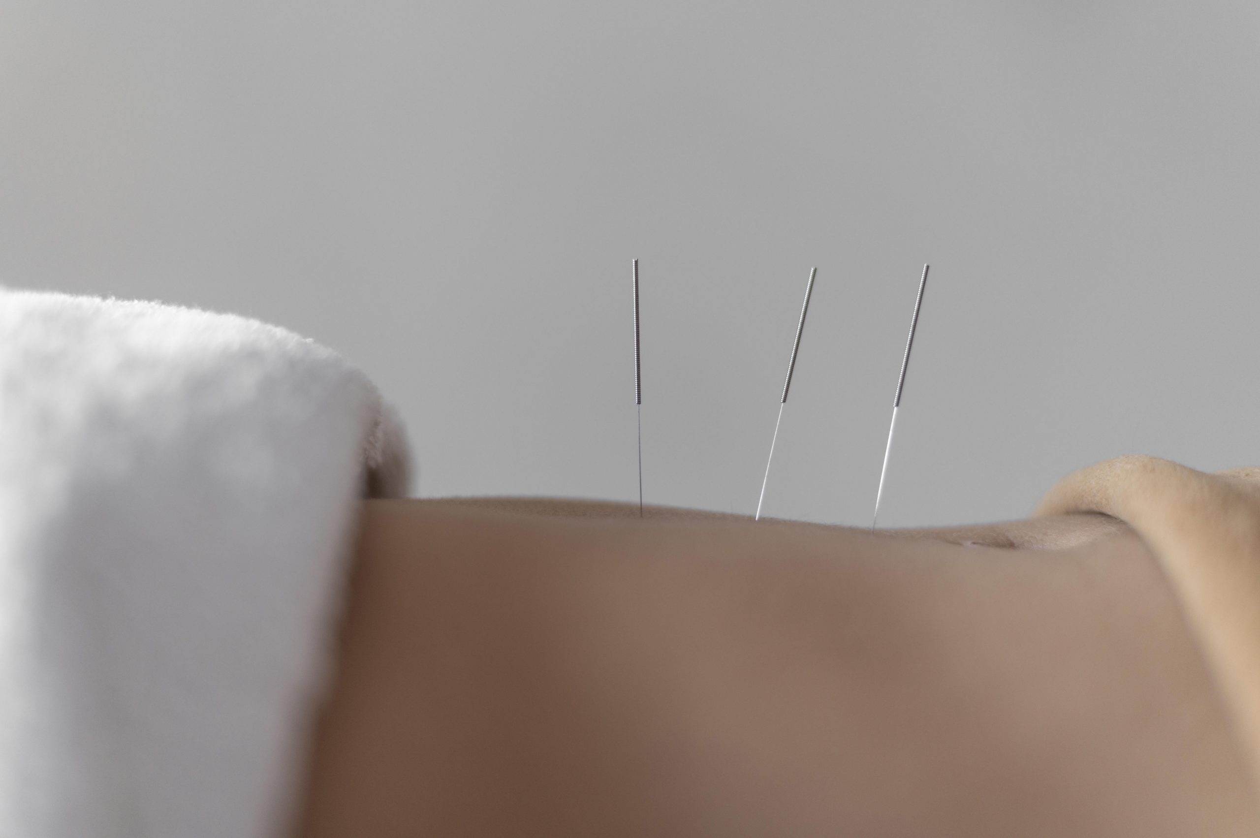 close-up-acupuncture-procedure acupuncture