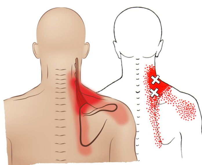 Acupuncture for Shoulder and Neck Pain Treatment