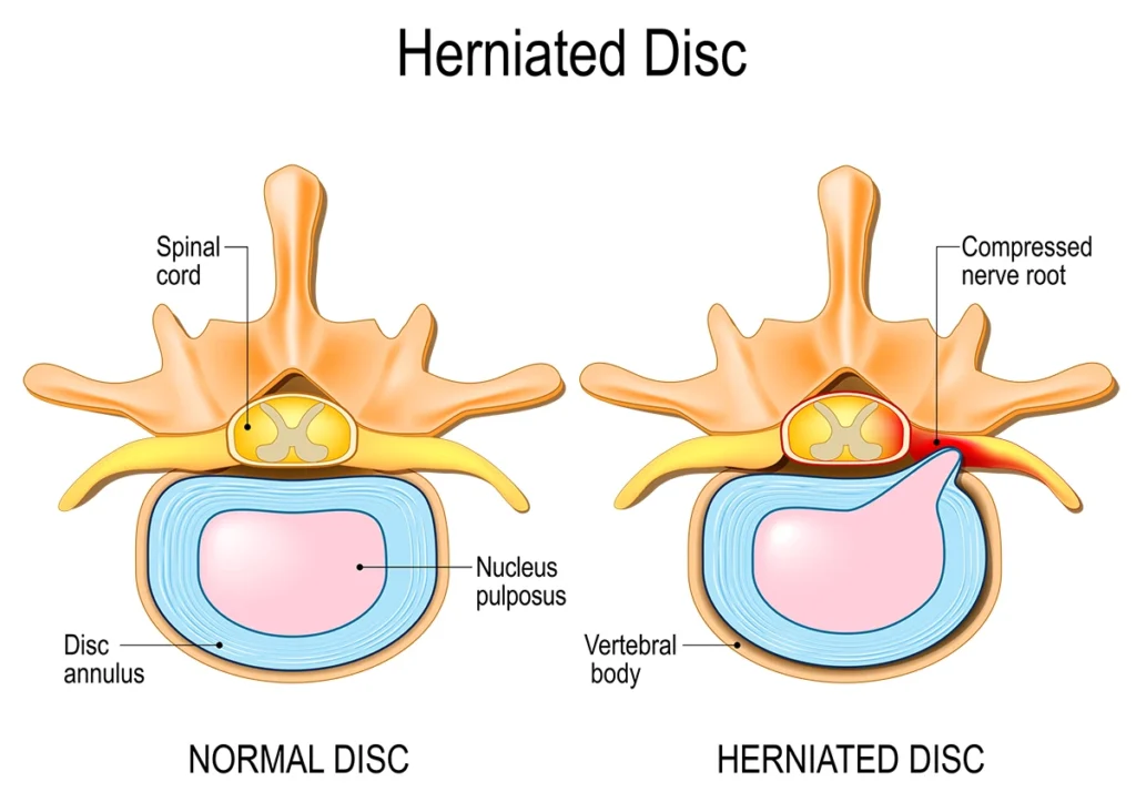 herniated disc