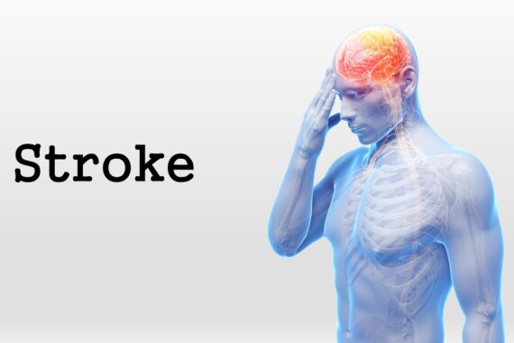 stroke hemiplegia