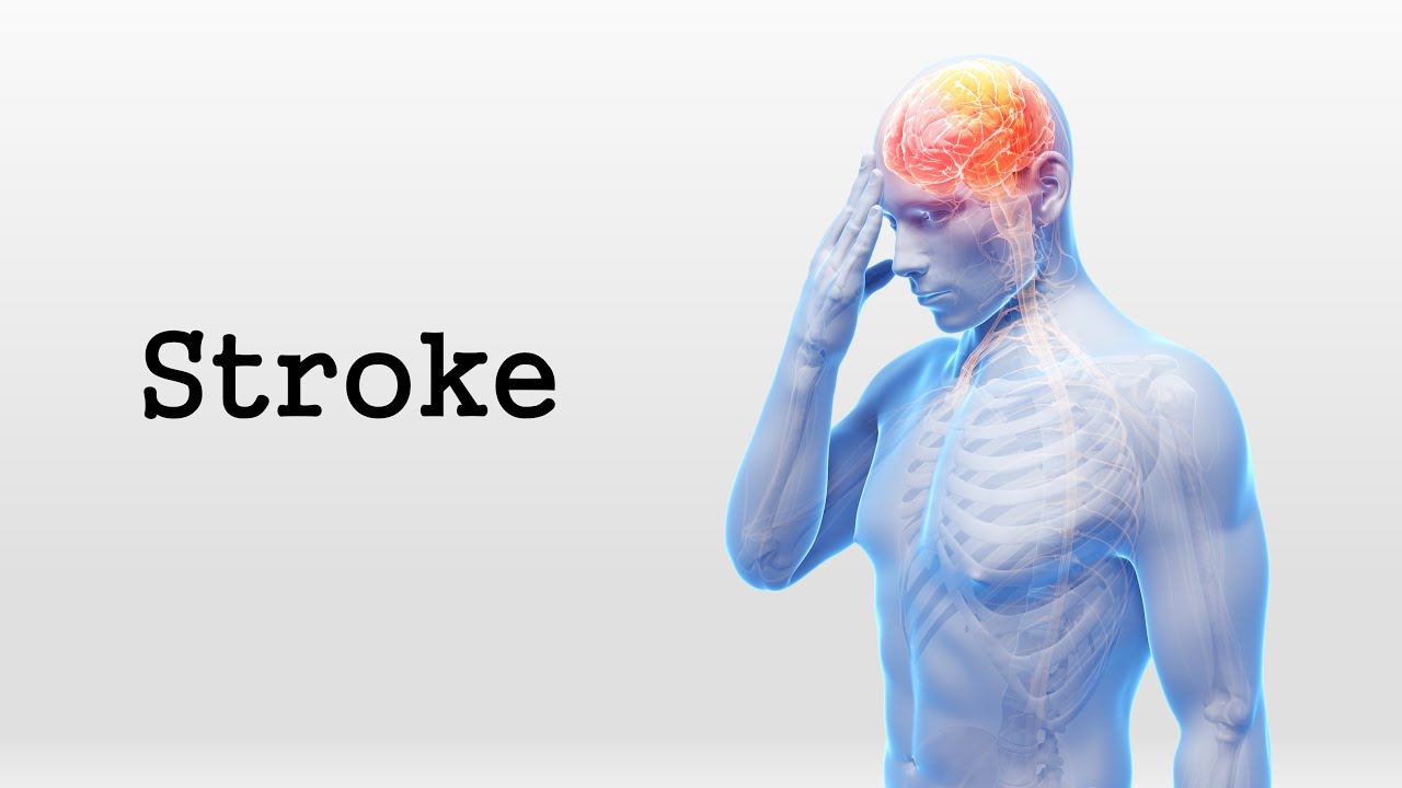 stroke hemiplegia