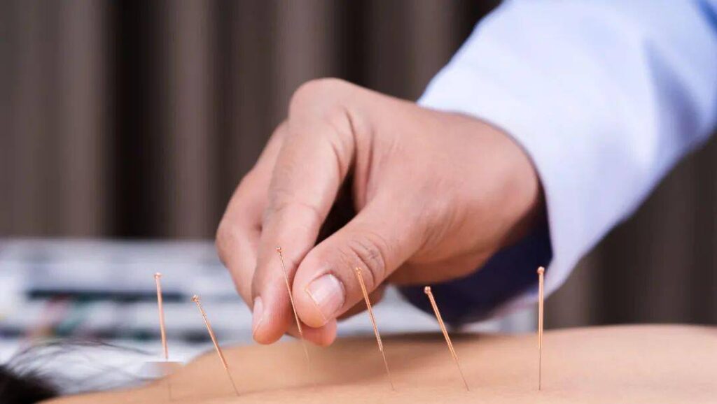 acupuncture for endometriosis acupuncture for endometriosis