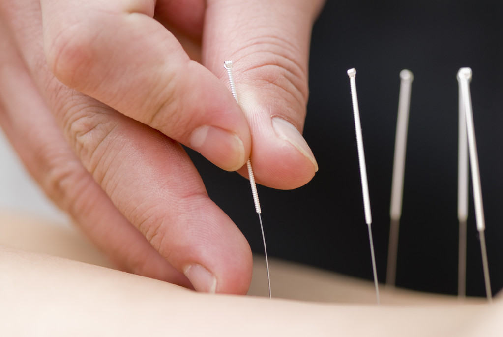 cosmetic acupuncture