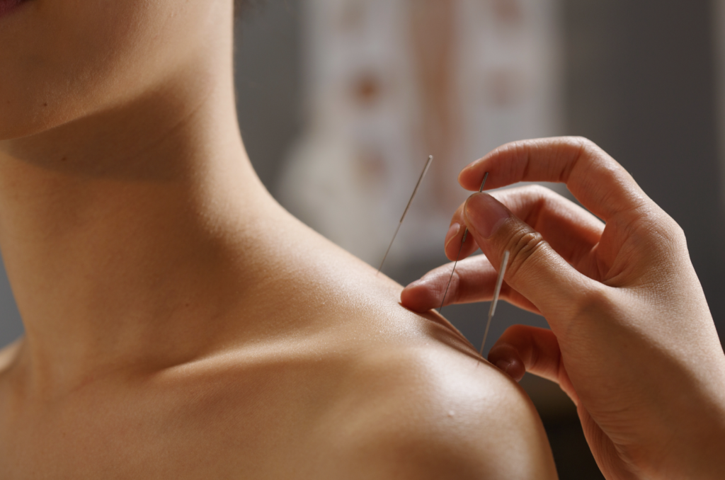 acupuncture for shoulder and neck pain